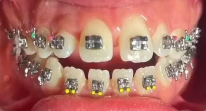 Ảnh Trước