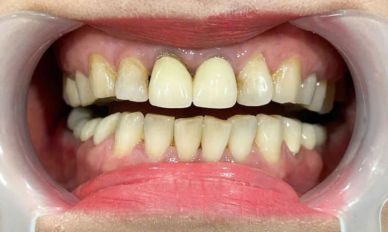 Ảnh Trước