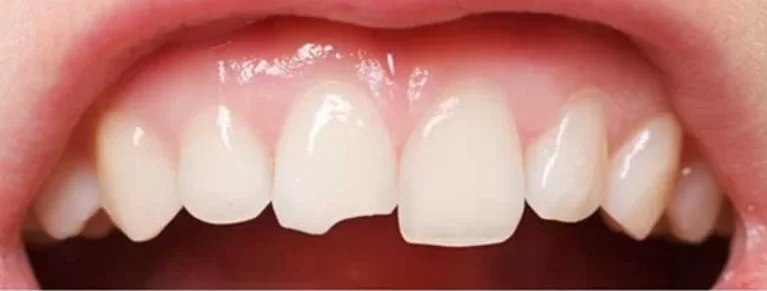 Ảnh Trước