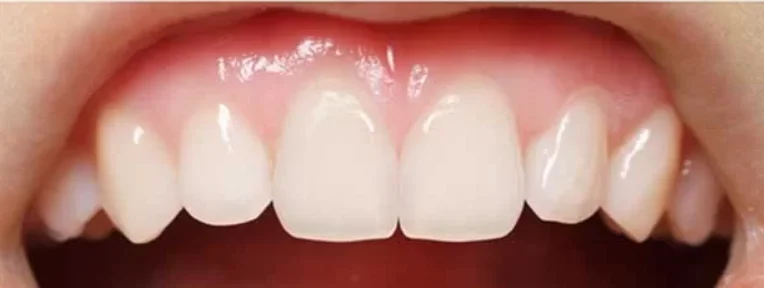 Ảnh Sau