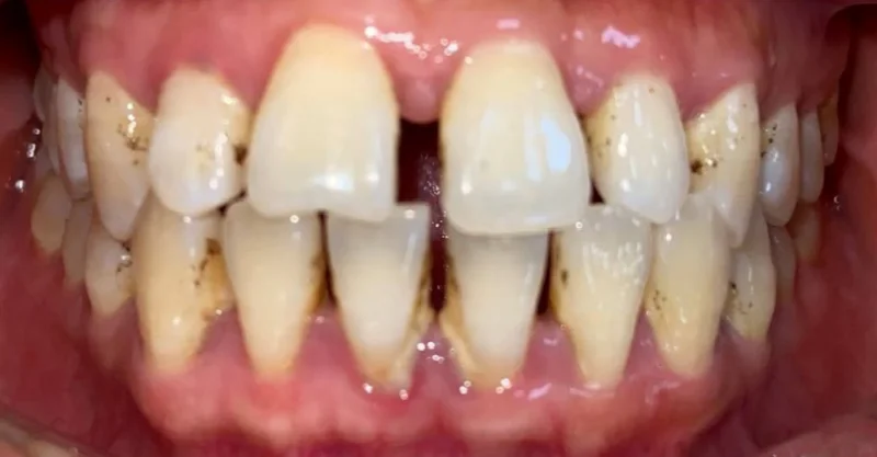 Ảnh Trước
